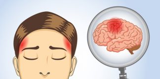Omkring 60 tusen huvudsjukdom av dem led av migrän - kronisk smärta